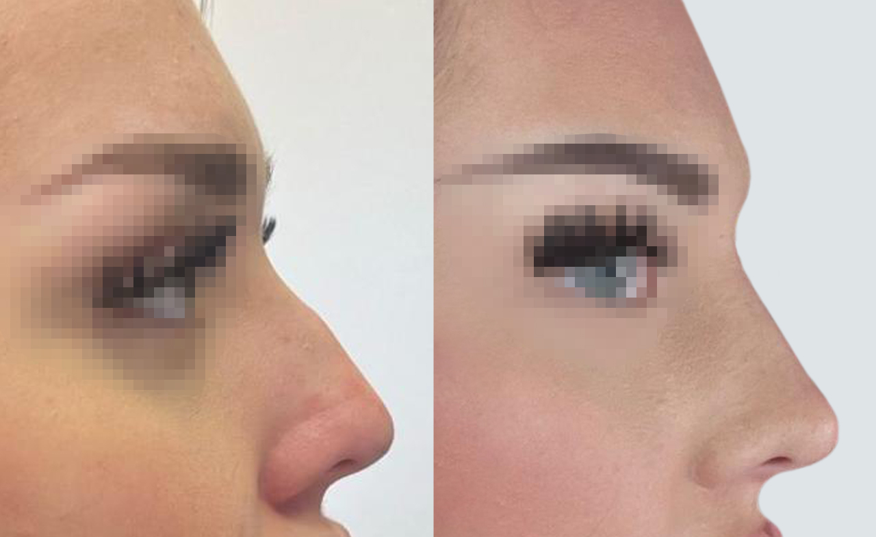 Vorher- Nachherbild einer jungen Frau mit Nasenkorrektur